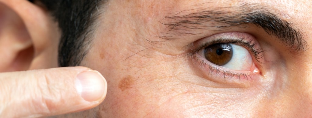 detail of facial melanoma on middle aged man picture id1214692943 1 1