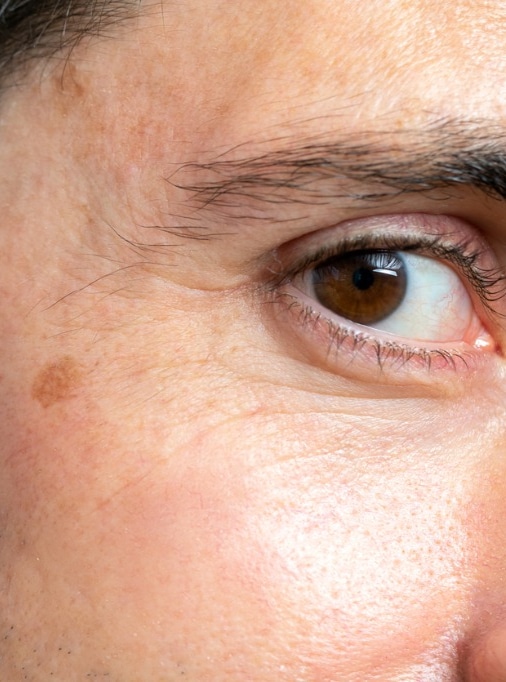 detail of facial melanoma on middle aged man picture id1214692943 2