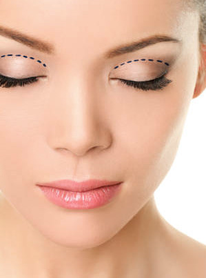 Asian Eyelid surgery