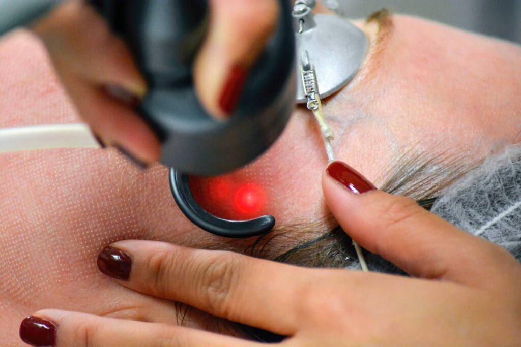 Close-up of a nurse performing a full face CO2 Fractional laser procedure on a female patient.