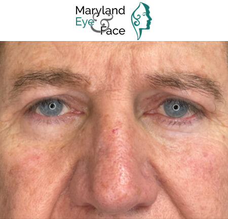 Close-up of an older man's face with blue eyes, slightly red eyelids, and visible skin texture. "Maryland Eye & Face" logo is at the top.