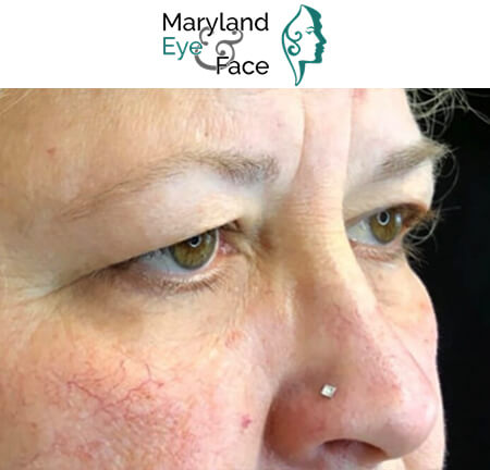 Close-up side view of a woman's eyes and nose featuring a small, square nose stud, with the Maryland Eye & Face logo above.