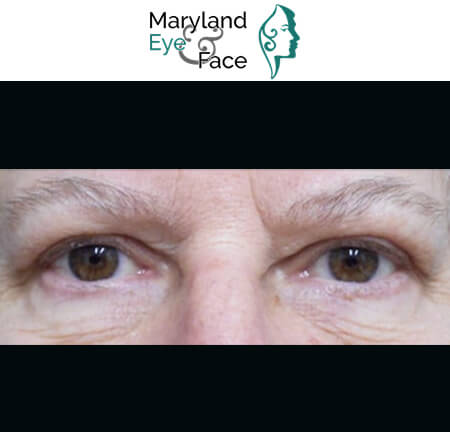 Close-up of a middle-aged person's eyes and brow area, featuring the Maryland Eye & Face logo above.