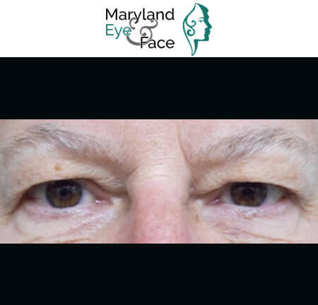 Close-up of a middle-aged person's eyes and brow area, featuring the Maryland Eye & Face logo above.