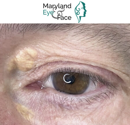 Close-up medical image of a brown eye with prominent aging signs, including yellow deposits (likely xanthelasma) on the inner upper eyelid, above the Maryland Eye & Face logo.