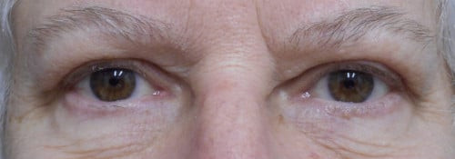 Blepharoplasty Upper Eyelids