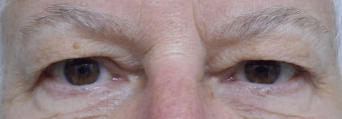 Blepharoplasty Upper Eyelids