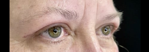 Blepharoplasty Upper Eyelids