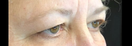 Blepharoplasty Upper Eyelids