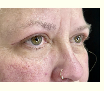 Blepharoplasty Upper Eyelids