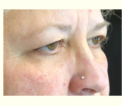 Blepharoplasty Upper Eyelids