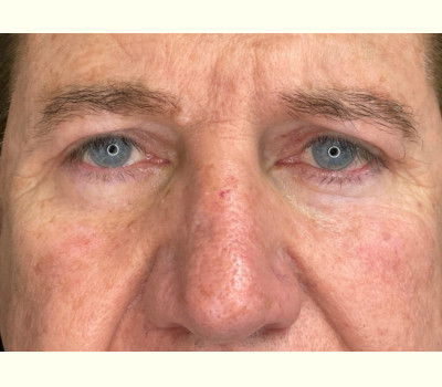 Blepharoplasty Upper & Lower Eyelids