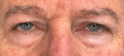 Blepharoplasty Upper & Lower Eyelids