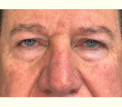 Blepharoplasty Upper & Lower Eyelids